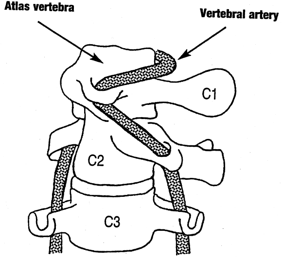 Disección vertebral
