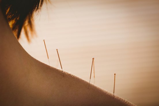 Historia de la acupuntura china