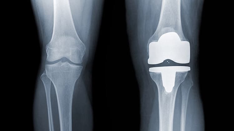 tiempo de recuperación protesis rodilla