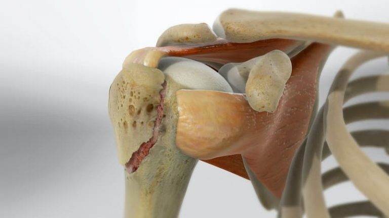 Fractura De Troqu ter Dolor Tratamiento Y Tiempo De Recuperaci n JL fractura-de-troqu-ter-dolor-tratamiento-y-tiempo-de-recuperaci-n-jl