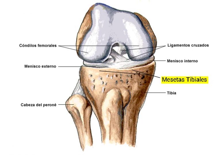 Fractura en la meseta tibial: tiempo de recuperación, tratamiento, secuelas