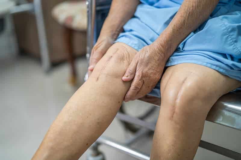 Limitacion con protesis de rodilla