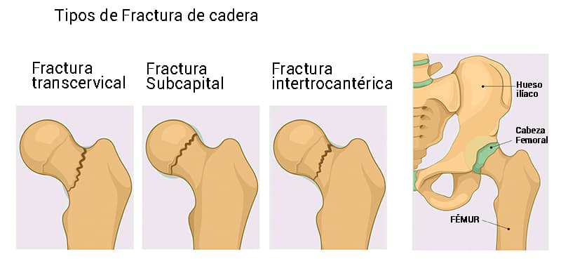 Fractura de femur clasificación