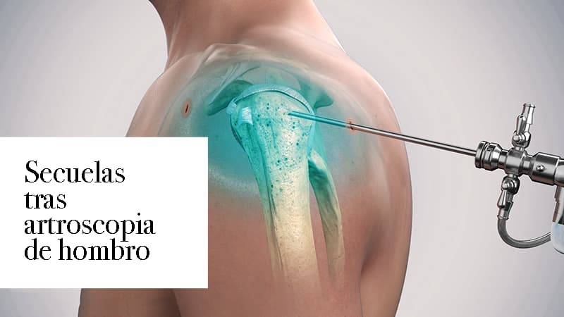 Secuelas tras artroscopia de hombro