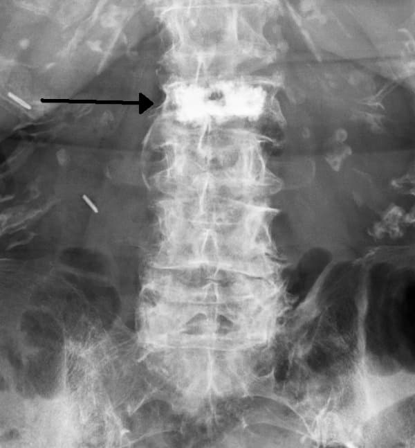 Radiografía vértebra L1 aplastada con vertebroplastia