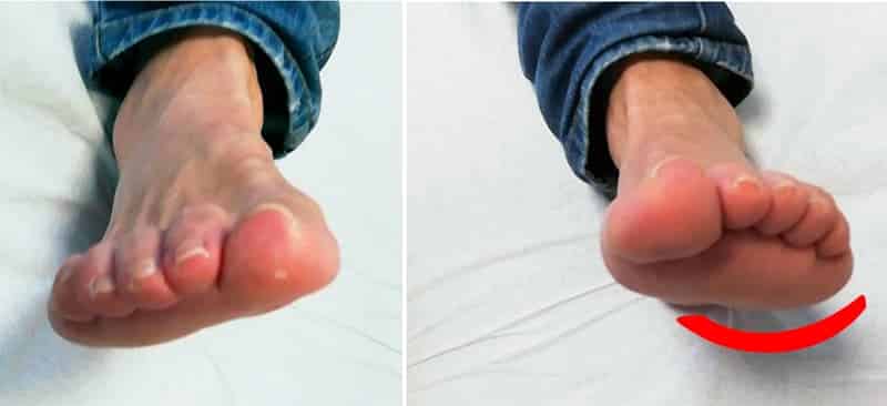 capsulitis dedo pie