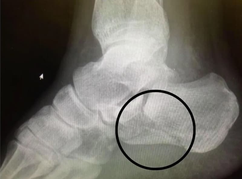 Radiografía de una fractura de la articulación calcánea